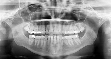 I-Max 2D Wall Mounted Digital Panoramic X-Ray Machine