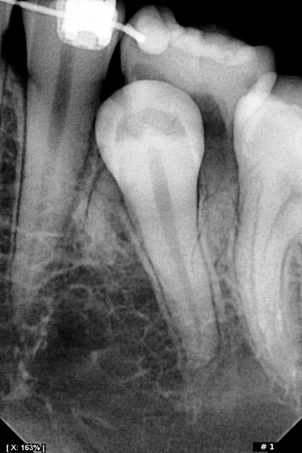 Videograph HD Digital Dental X-Ray Sensors