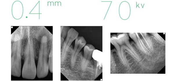 Genoray PortX IV Handheld Dental X-Ray Unit